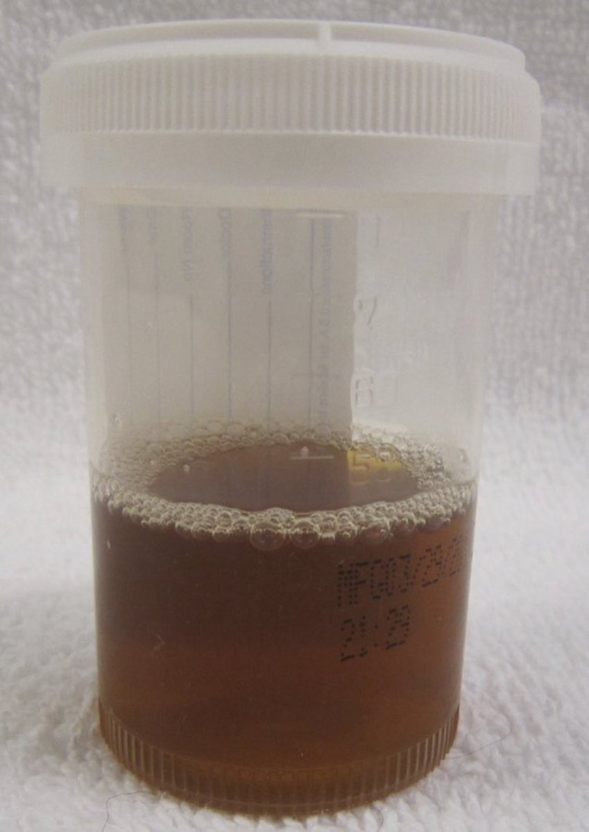 A 18 year old man presented with muscle ache after intense workout. What is the likely diagnosis? (Image: Wikipedia) #medtwitter