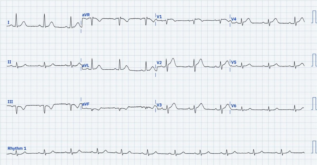 79 YOM fall/collapse, confusion, lethargy, pale
Minimal inferior ST ⬆️ ECG was recorded first 
Hyperactute T wave + septal ST⬆️ ECG recorded 27 minutes later