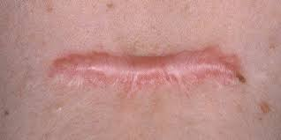 hkxxkrjp's tweet photo. Parut ni nampak tak nampak ke tetap rasa insecure kan? 😭

Parut jatuh, kene jahit semuanya boleh hilang kalau kena cara tau. Mommy yang bersalin czer yang ada keloid pun boleh guna tips ni. Kalau konsisten, insyaAllah boleh hilang 🤍

Bebenang ringkas untuk rujukan 🧵 https://t.co/vxJoKumL1f