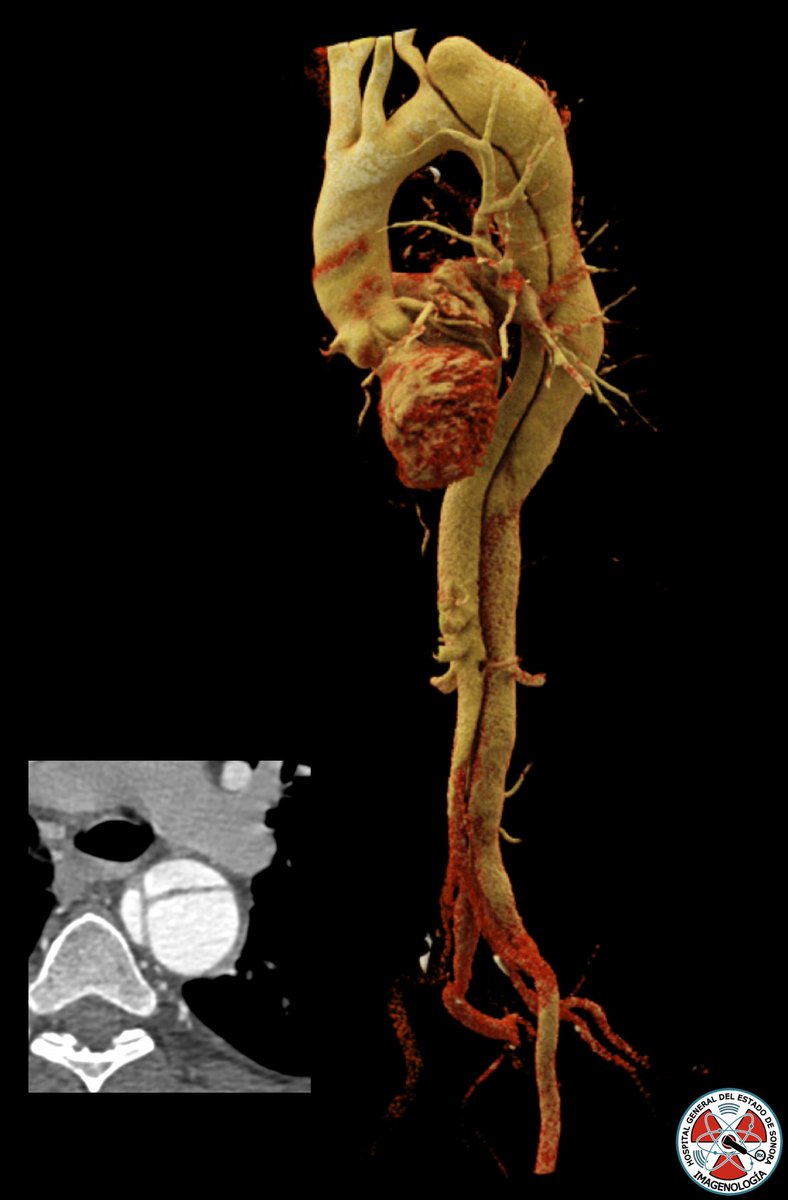 ¿Cuál es tu impresión diagnóstica? #radiology #radres #cinematicrendering  <a href="/XochitlMadrid1/">Fernanda Madrid</a>