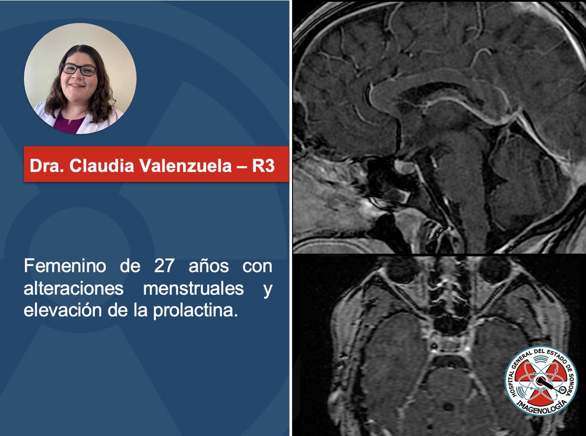 Imágenes de RM de encéfalo potenciada a T1 con contraste en planos sagital y axial. ¿Cuál es el diagnóstico? 🧠 🧐

#Radiology #MRI #Brain #BrainMRI #FOAMed #FOAMrad #RadRes <a href="/claudiarx18/">Claudia V.</a>