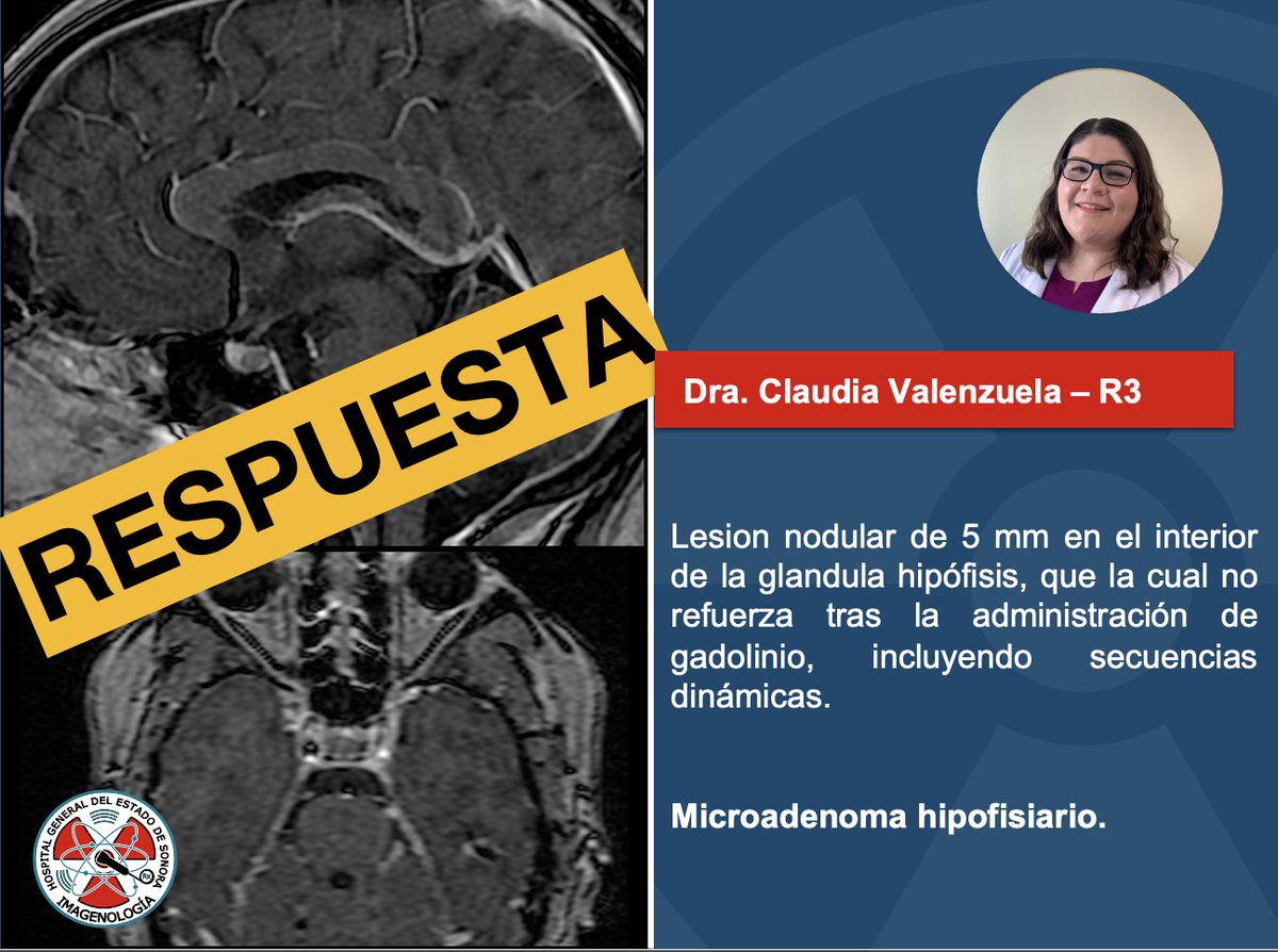 Respuesta del caso 🙌. 

#MRI #Brain #Radiology #RadRes #FOAMed #FOAMrad #BrainMRI <a href="/claudiarx18/">Claudia V.</a>