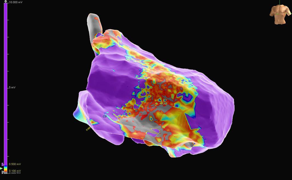 mertilkerh's tweet photo. Septal incessant #VT in a 48y M patient with NICMP. Tachycardia first terminated from epicardial access. Due to inducibility ablated from the LV endo cite. #AblateVT,#Epeeps great maps from @vebedu https://t.co/XSCbJRyN4u