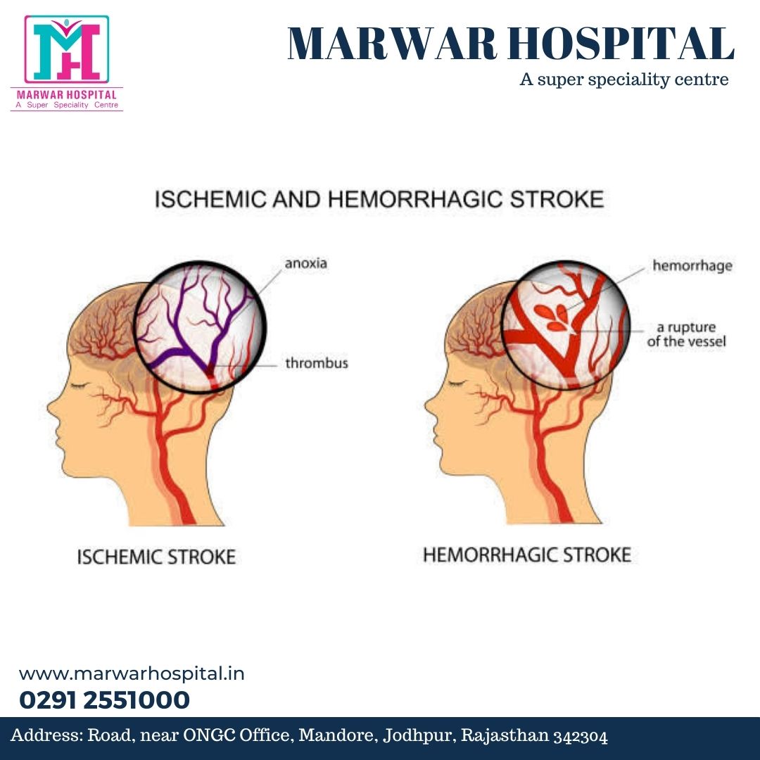 MarwarHospital's tweet photo. Ischemic and hemorrhagic stroke..

Call us to consult 📞  0291 2551000

Marwar Hospital A super speciality centre ...

Follow us for daily update ... 

#marwarhospital #marwarhospitaljodhpur #besthopital #hospitalinjodhpur https://t.co/IfIQO8G9dr