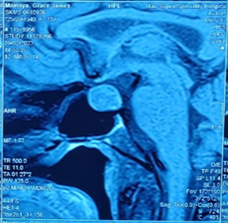 DrAmbrishMithal's tweet image. Yesterday's academic program.
Discussion about a case of #Acromegaly- #pituitary adenoma
with DNB fellows- by Kunal Rupwane 
Focus on  #diagnosis and investigations
Protocol discussion by Nupoor Vaghasiq
So much to learn, every Thursday
#Endocrinology
#tumor #growthhormone