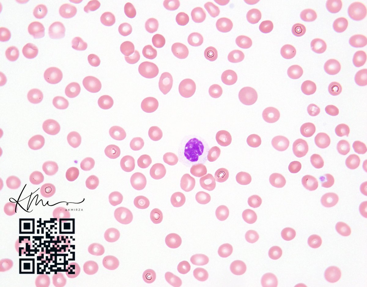 #pathology #leusm #mdssm #OnlyCells What is this peripheral smear image telling you?