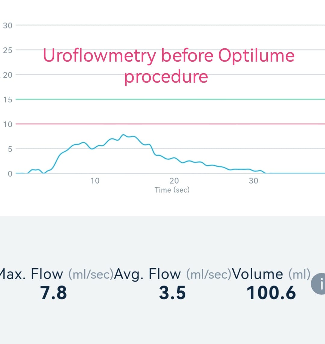 OTosev's tweet photo. Can #uroflowmetry be significantly improved if you have bulbar #urethralstricture?The answer is-YES!Here you can see the difference before and after successfully performed #Optilume treatment by https://t.co/Kp4p9GaadA.univ.Georgi Tosev https://t.co/LuY9BEHfrj