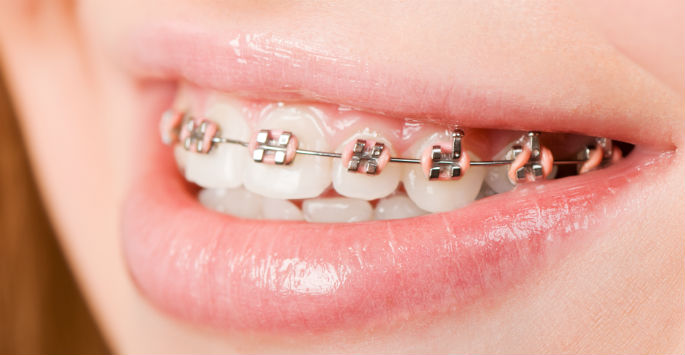 Raganortho's tweet photo. Speed Up Your Orthodontic Treatment with AcceleDent™ A device is worn in your mouth… #Dallas https://t.co/etQ3zBolwx https://t.co/KUYCU18isE