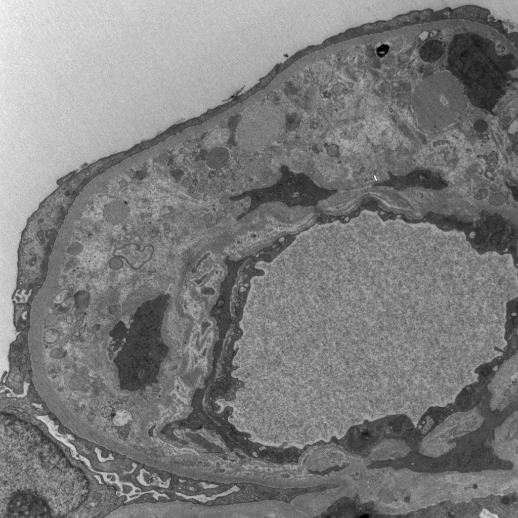 I feel like I keep getting great examples of anti-VEGF-induced TMA. Here is one w/ nice EM showing prominent subendothelial widening with flocculent material and new GBM formation. LM with capillary lumen closure, fragmented RBCs, and GBM reduplication. #RenalPath