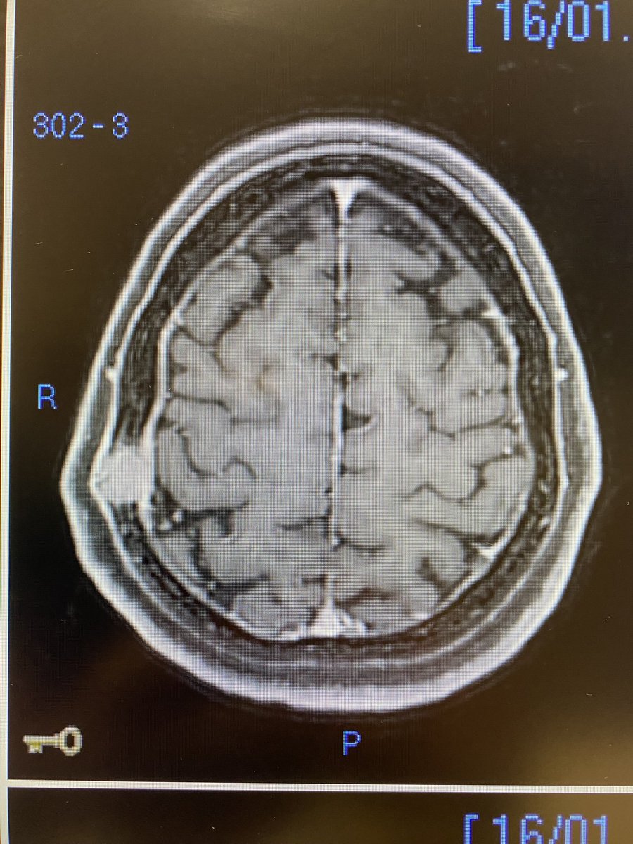andrepcdc's tweet image. 49yo, female, sporadic/acquired FH deficient Papillary Renal Cell Carcinoma with bone-only recurrence 10m after nefrectomy. Only 2 mets, but symptomatic (pain) and growing towards the brain. Radioresistant…