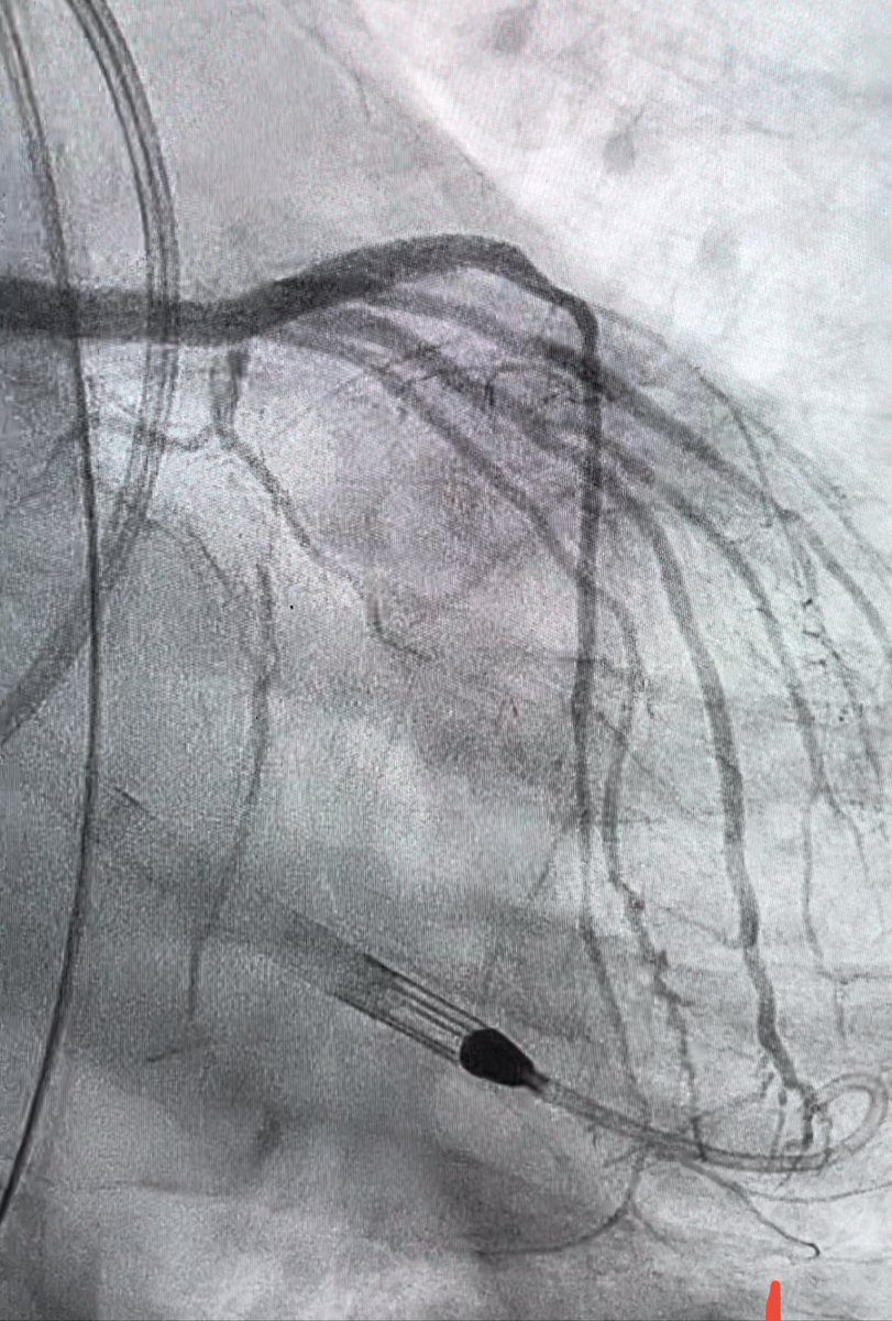Anja Øksnes (@anjaksnes) on Twitter photo Amazing to be doing cases with the best - <a href="/mbmcentegart/">Margaret McEntegart</a> world class skills-so proud to have been a part of #CTO2023 . Tough case -amazing result <a href="/crfheart/">Cardiovascular Research Foundation</a> <a href="/SabaAssar/">Saba Assar, MD ❤🦄</a> @ajaykirtane Amazing to be doing cases with the best - <a href="/mbmcentegart/">Margaret McEntegart</a> world class skills-so proud to have been a part of #CTO2023 . Tough case -amazing result <a href="/crfheart/">Cardiovascular Research Foundation</a> <a href="/SabaAssar/">Saba Assar, MD ❤🦄</a> @ajaykirtane