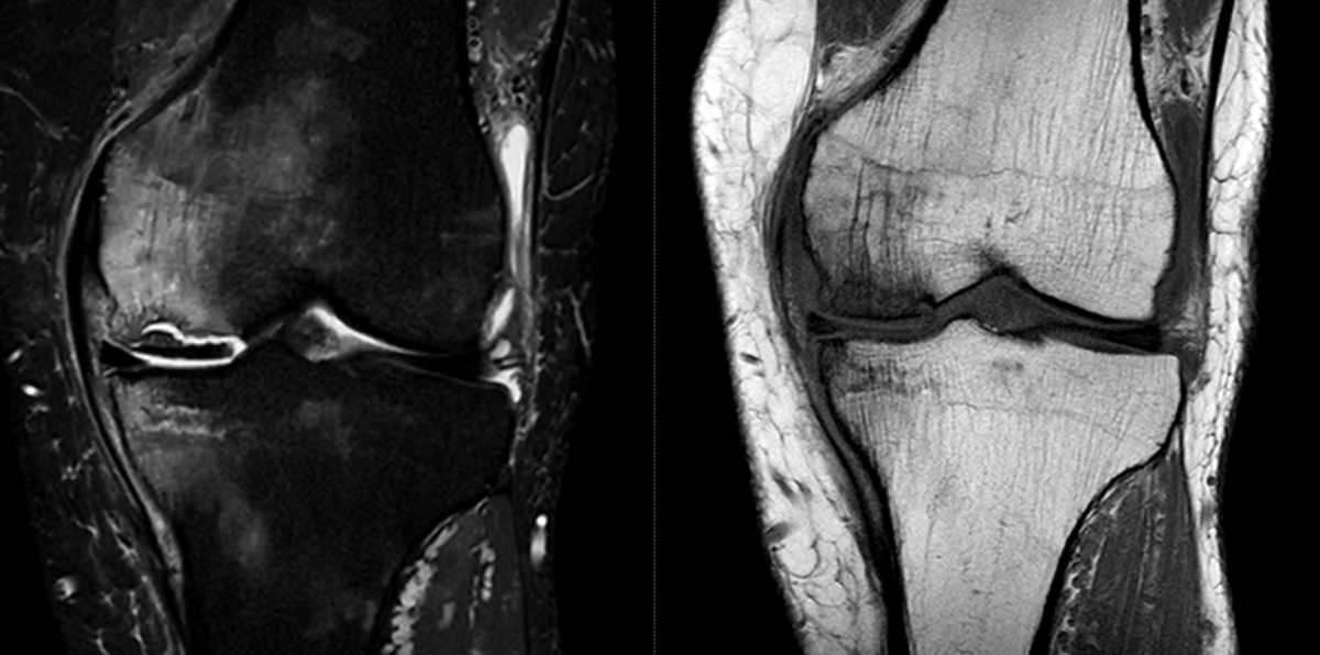 End Stage of SIF in medial condyle.  Established osteonecrosis with signs of instability.
Concomitant insufficiency Fx tibial plateau.
MM root tear (not shown).
#msk #mskrad #ortho #orthotwitter