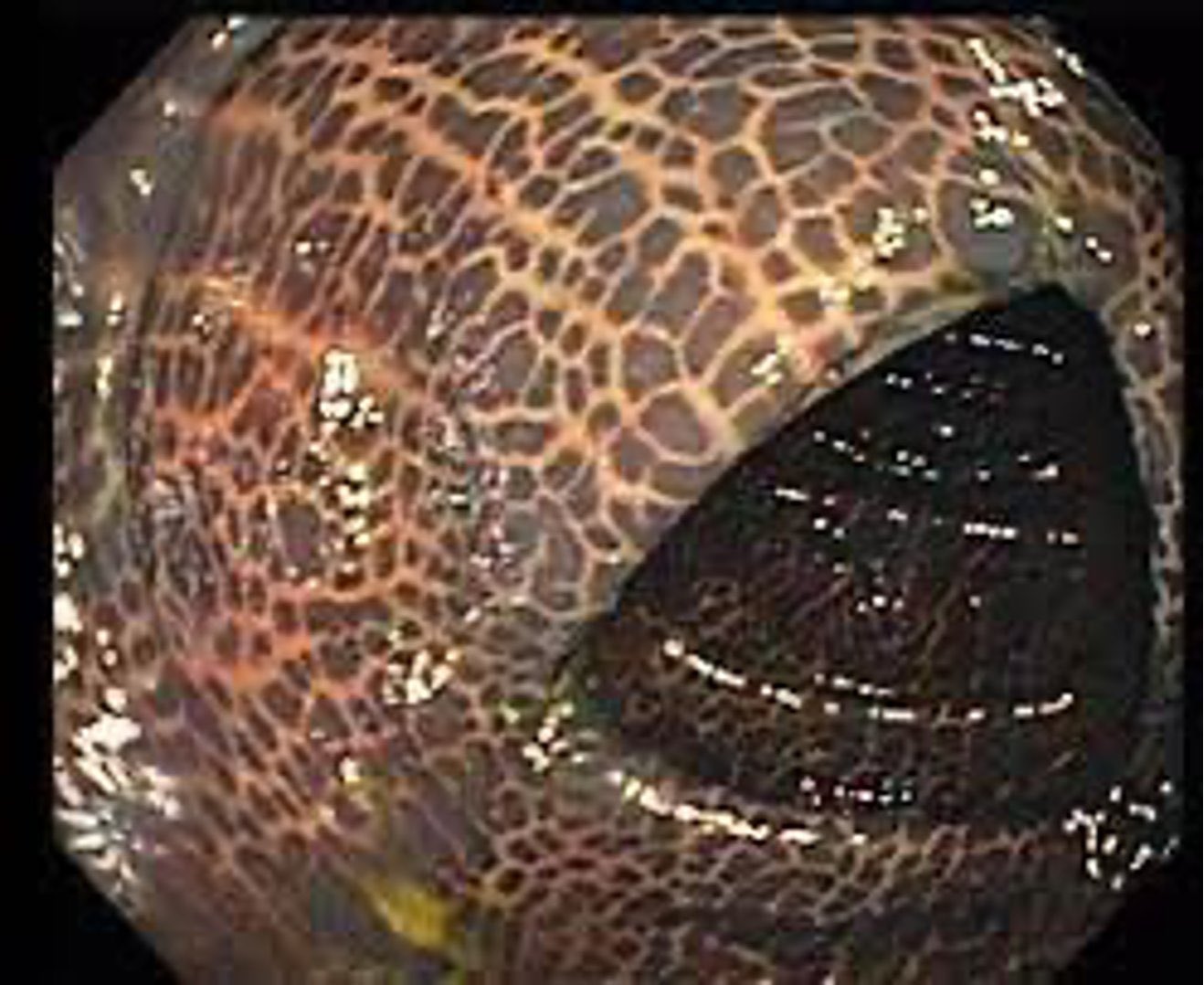 Jyoti on X: RT @drkeithsiau: Elderly woman with “leopard print” mucosa on  colonoscopy. What is the diagnosis?  / X