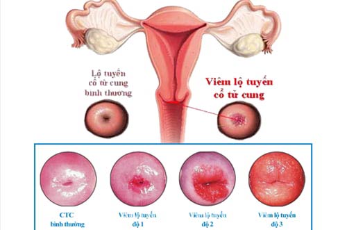 bstranthithanh's tweet photo. Top 11 Địa chỉ chữa đốt viêm lộ tuyến cổ tử cung ở đâu tốt Hà Nội
#chuaviemlotuyencotucungodau #dotviemlotuyenodautot #khamviemlotuyenodau
https://t.co/4ssZckp86L https://t.co/8rXzFJDQ5A