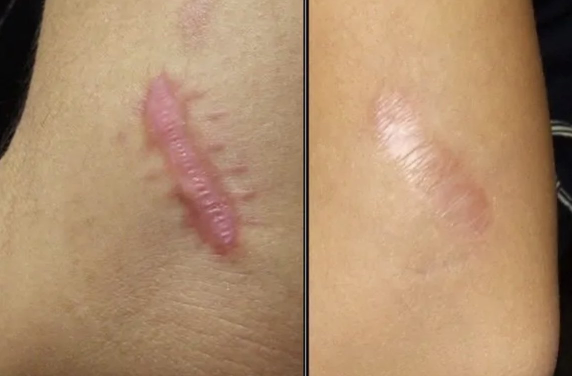 ezzahnor's tweet photo. Top 5 scar treatment cream/serum that most people recommends 🤍

-A thread https://t.co/OUHa62PJxC