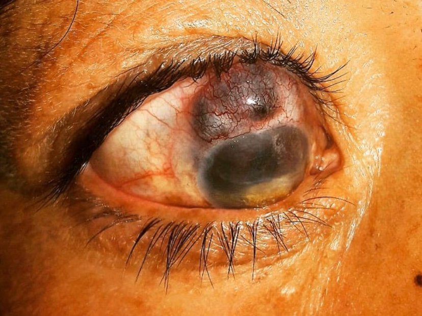 joptoophthal's tweet photo. Scleromalacia perforans also known as Necrotizing scleritis without inflammation. It is a rare, severe eye disorder developing an autoimmune damage of episcleral and scleral performing vessels.
#scleromalacia #perforans #scleritis #eyedisorder #infection https://t.co/4VqaeUD2Ds