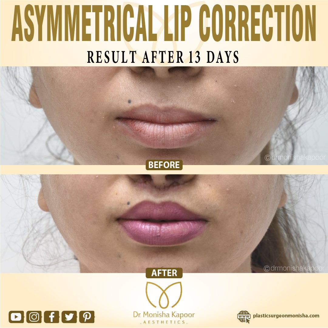 This patient had an asymmetrical lip. In the before picture you can see her top right lip was smaller and lower. We corrected asymmetry and were able to achieve near perfection!

#lipcorrection #asymmetricallips
#lipaugmentation #liplift
#lipfillers 
#lipliftsurgery