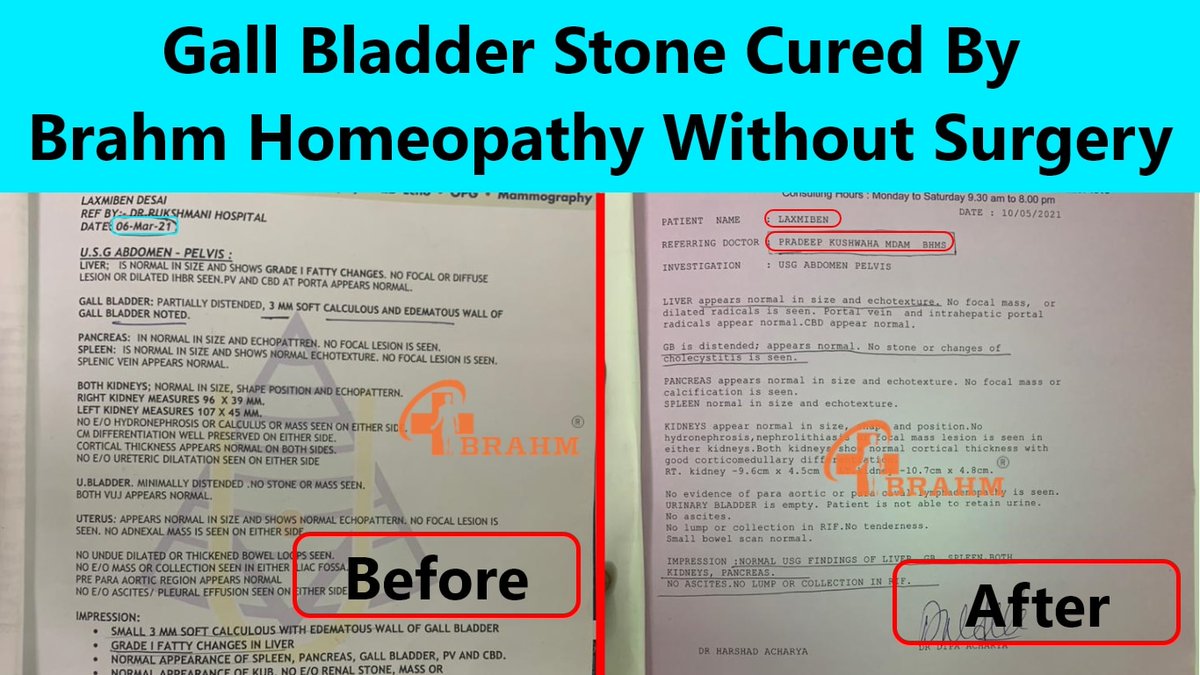 BrahmHomeopathy's tweet photo. Cured report of patient of Gall Bladder Stone
#drpradeepkushwaha #brahmhomeo #homeopathy #gallbladderstone #gallbladder #treatmentofgallbladderstones #cuses #symptoms #treatment #prevention #disease #infection #health #healthtip #healtheducation #heathylifeatyle https://t.co/D06gZIrcme
