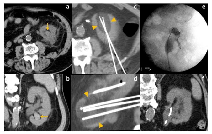 Take a look at this #ShortCommunication
Salvage Percutaneous #Cryoablation for Bleeding Upper Tract Urothelial #Carcinoma
link.springer.com/article/10.100…