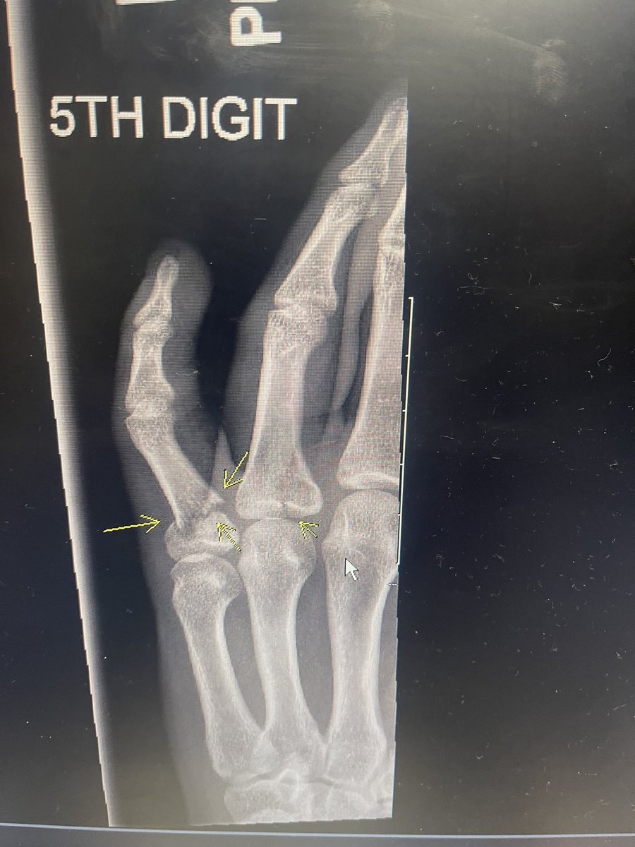 PAFitness13's tweet photo. Well, good news is finished the season with 2 solid hits, bad news is the season is now finished.  Slide into 3rd, two broken fingers.  That’s all she wrote. Kid can’t catch a break.  #moreinjuries. https://t.co/bZNH0Ap5qT