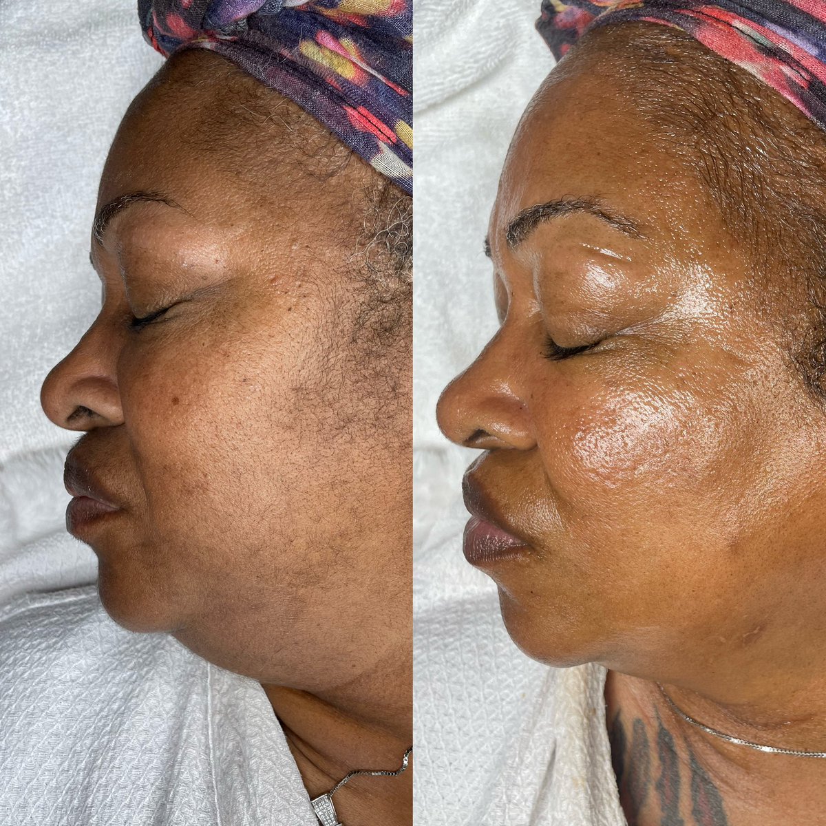 GLOSKINLAB's tweet image. super refreshed, super juicy. book the porcelain doll glo now! 🖥💓 

the formula? dermaplaning, cherry enzyme treatment, + LED light therapy to treat hyperpigmentation.