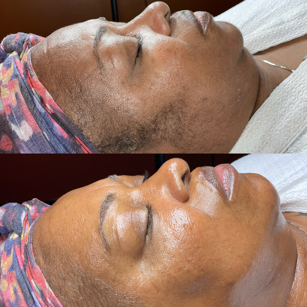 GLOSKINLAB's tweet image. super refreshed, super juicy. book the porcelain doll glo now! 🖥💓 

the formula? dermaplaning, cherry enzyme treatment, + LED light therapy to treat hyperpigmentation.