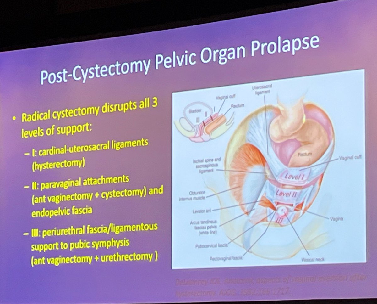 DrSCohen's tweet photo. .@SandipVasavada @CleClinicUro with comprehensive insight into the complexities of #surgicalmanagement of #postcystectomy vaginal #prolapse. Usually more akin to a separation of vaginal wall with #peritoneum descending into the canal. #Prevention is key. #SUFU23. @sufuorg https://t.co/vytvrgrDUj