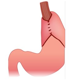 If a hot dog is a sandwich, is a Nissen a sandwich?