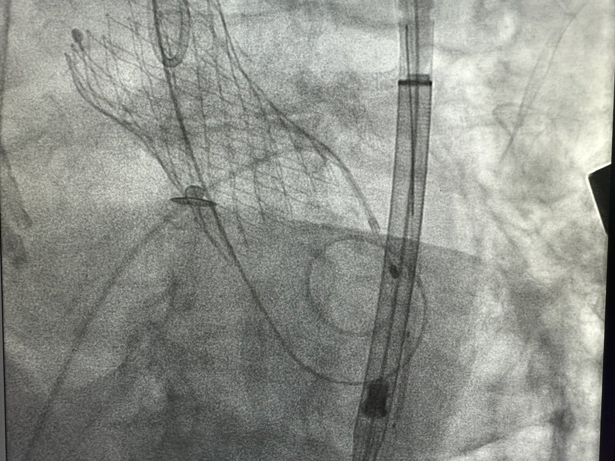 adrianocaixeta's tweet photo. Great Team work here in #Campinas, #SaoPaulo, Brazil with my colleagues for a #TAVI in a patient with close do zero aortic calcification. Will love to come back! Thanks @medtronic. #tavr #aorticstenosis #evolutpro https://t.co/nPMoMV5k5d