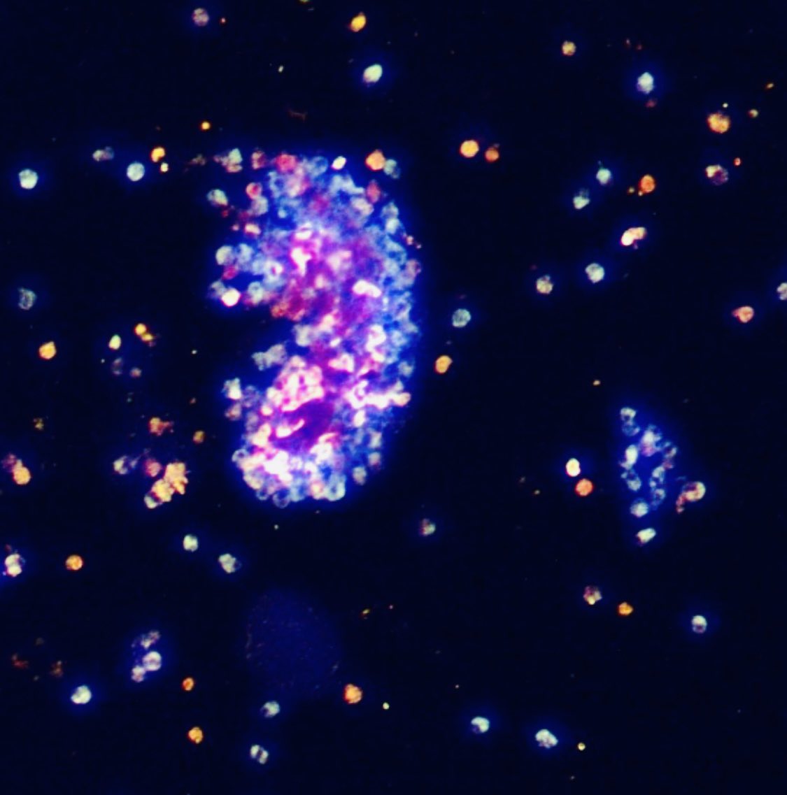 SwethaKanduriMD's tweet photo. Urine microscopy picturing calcium oxalate dihydrate crystals clumped into the shape of a “Kidney”. Happy #WorldKidneyDay2023                                 @OchsnerNephro #ProtectTheBeans @worldkidneyday @ASNKidney. Picture credit: @VelezNephHepato https://t.co/cBmrCgznV5