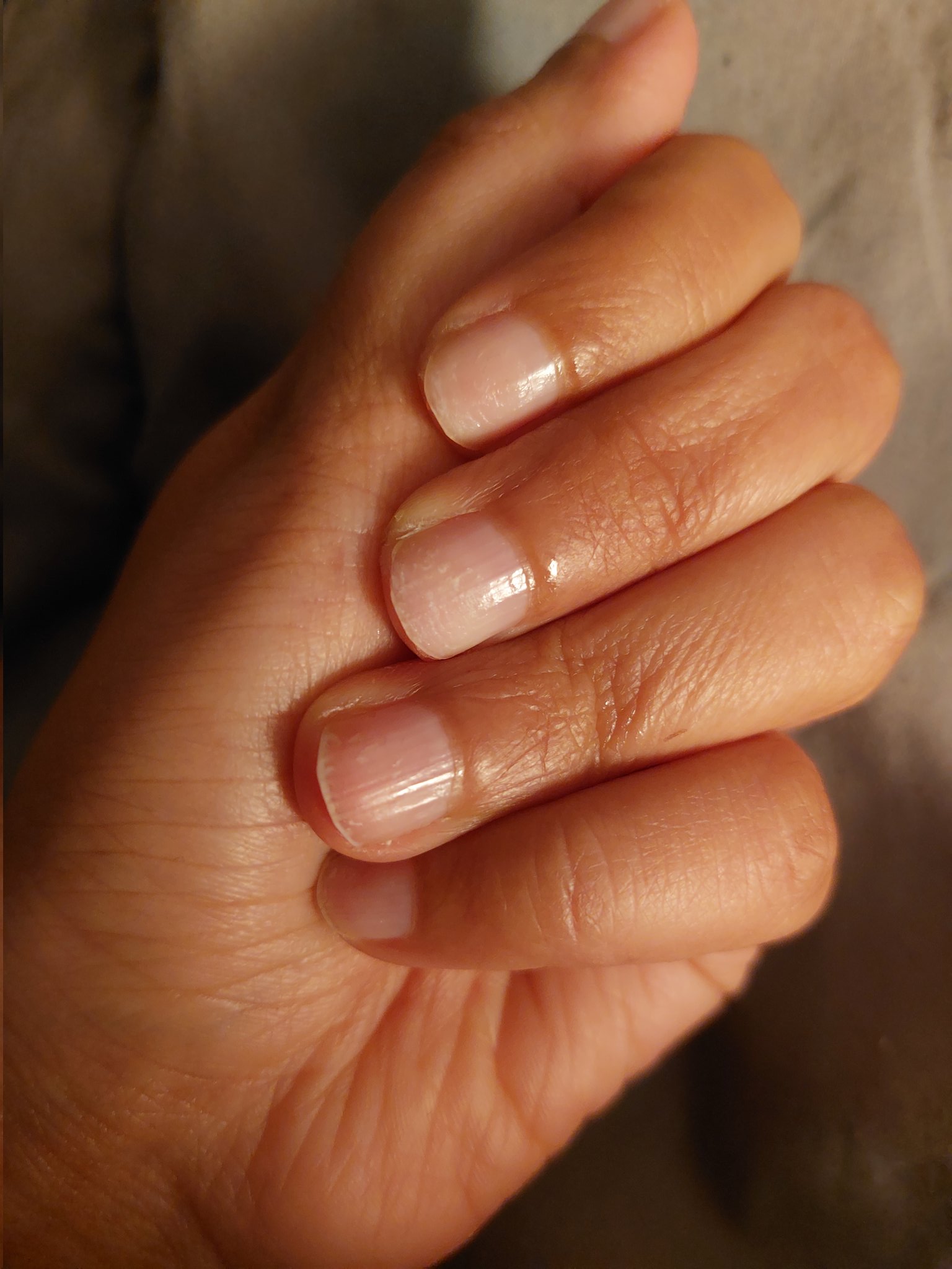 Im 15 and I have had nail pitting on my ring nail since I was nine. It's  recently started in my thumb (same hand) but have never had any other  symptoms. :
