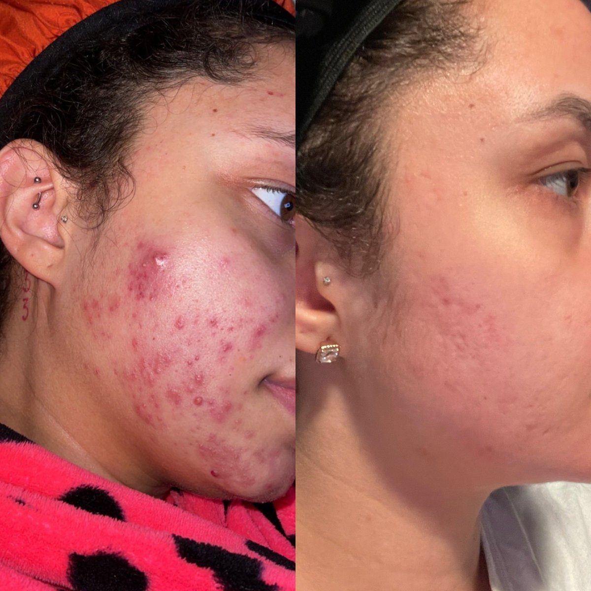 taradesthetics's tweet photo. my own skin journey hits hardest for me✨🫶🏼 https://t.co/W6Td1G3HB4
