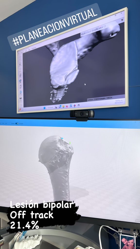 OrtoDrJuarez's tweet photo. Lesión de Hill Sach y Bankart óseo , off track y 21.4% #planeacionvirtual  #3dcot #orthotwitter https://t.co/flkZmc1Bhm