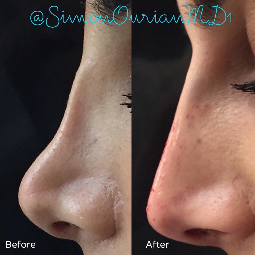 simonourianmd's tweet photo. Non-Surgical Nose Lift by Dr. Simon Ourian
#nosejob #nosugery #nonsurgical #noselift #plasticsurgery #juvederm #voluma #perlane #injection #fillers #monday #botchednose #rhinoplasty #restylane #transformation #makeover https://t.co/wRY96Srx4u