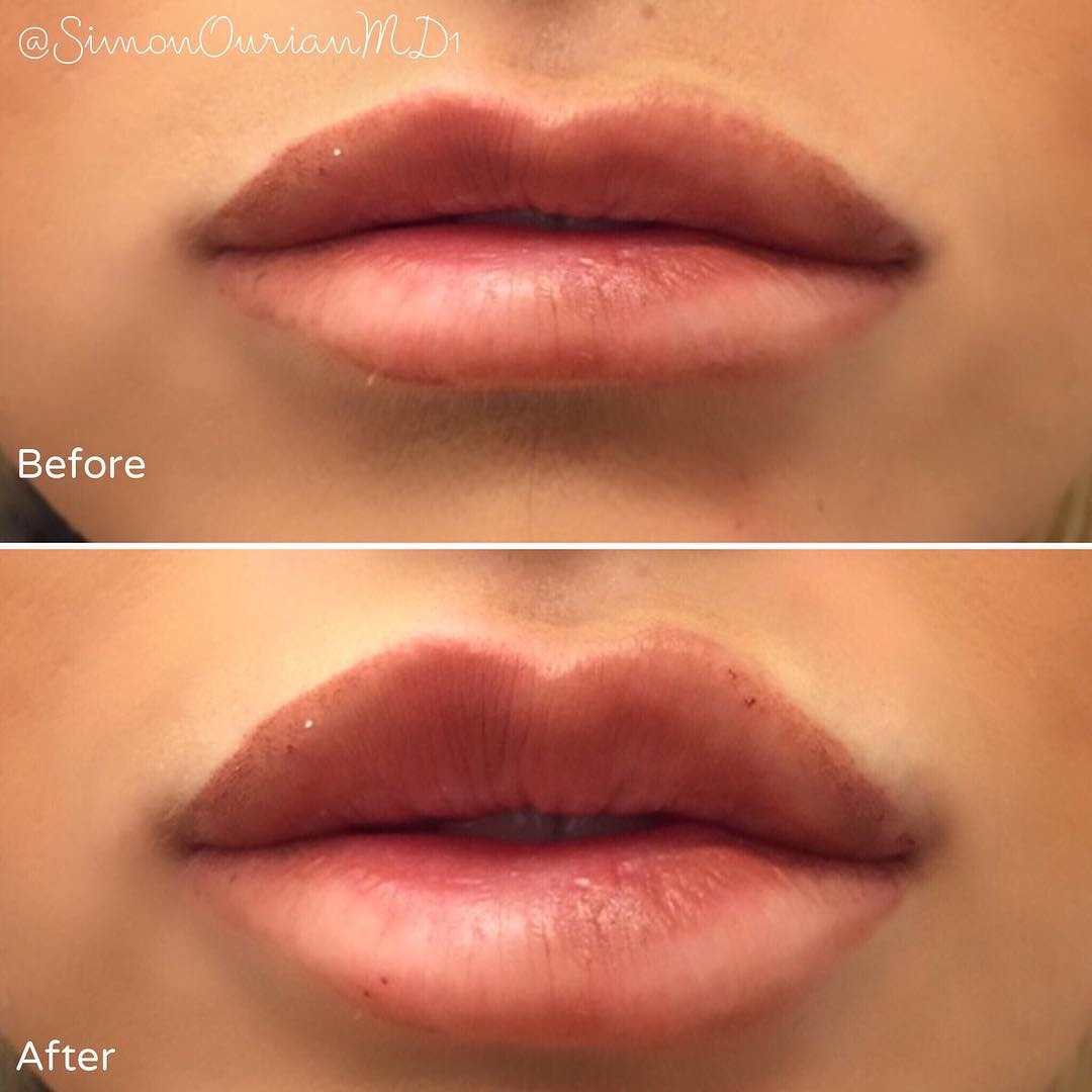 Lip Fillers by Dr. Simon Ourian

#lipenhancement #plumpinguplips  #cosmetic #fillers #lipaugmentation #lips #juvederm #voluma #restylane #transformation #makeover #beauty #beautiful #beverlyhills