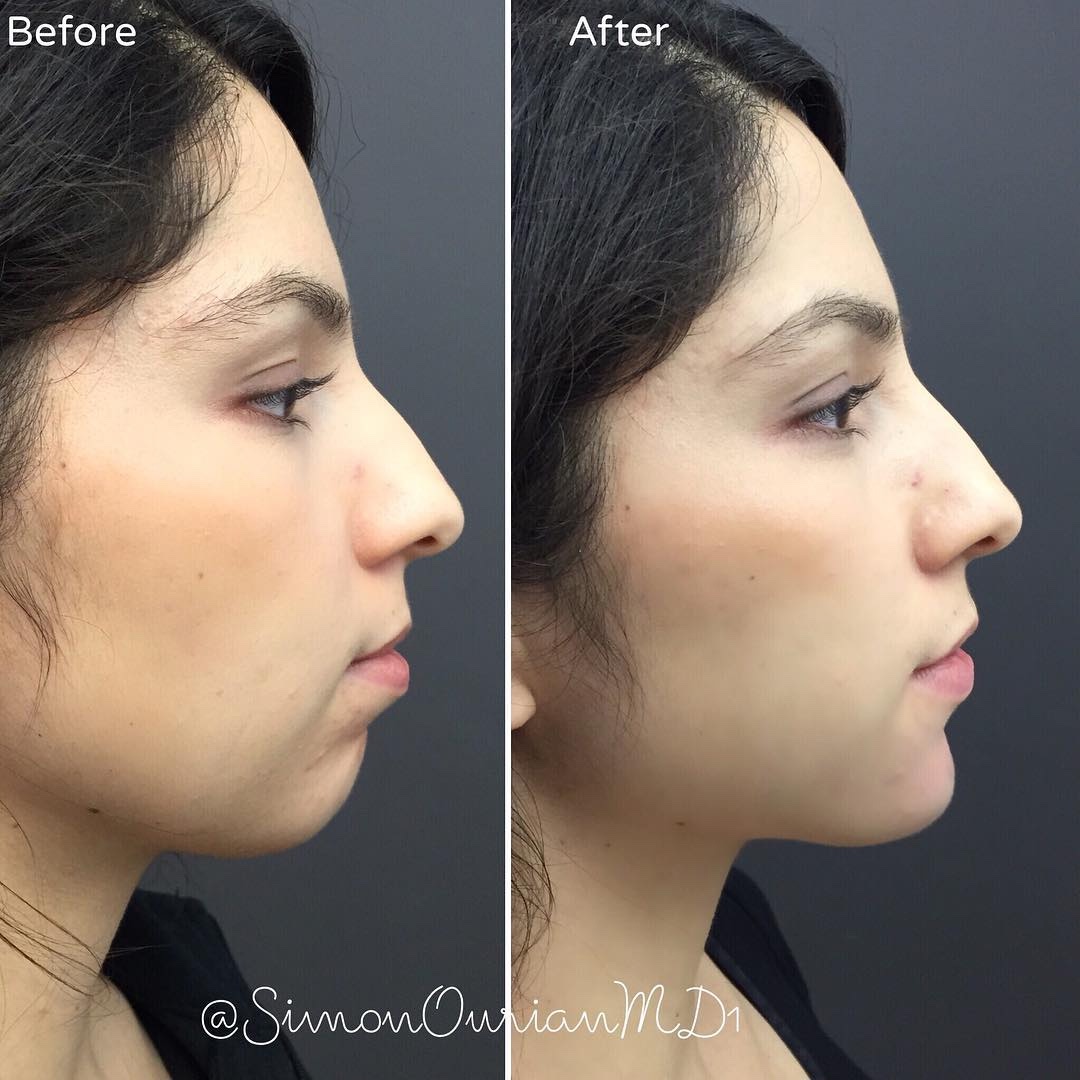 simonourianmd's tweet photo. Non-Surgical Chin Augmentation by Dr. Simon Ourian
#chinaugmentation #chin #doublechin #juvederm #voluma #sculptra #youthful #youth #beautiful #beauty #beverlyhills #losangeles #hollywood #california #socal #transformation #makeover https://t.co/K74yLX1tZW