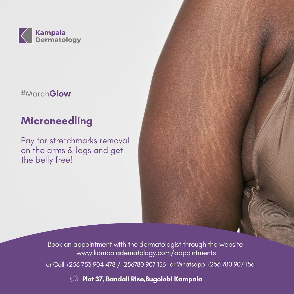 kladermatology's tweet photo. #MarchGlow
Are you suffering from stretch-marks? Take advantage of our March give away discount where you get a free belly stretch marksโ treatment if you pay for the arms & legs.
WhatsApp: 0780 907 156
#Kladermatology #skinglow #stretchmarks #BBTitans2023 #BBTitans #friday https://t.co/HGenjoxizn