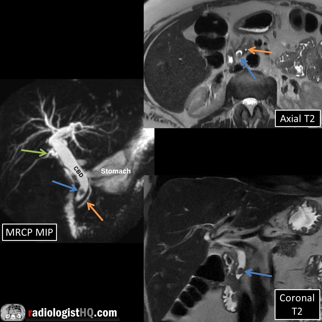 Choledocholithiasis (blue) after CCY. Cystic duct remnant (green), normal PD (orange) & stone-containing, dilated CBD. Post-CCY choledocholithiasis usually from retained or secondary stones from GB remnant or cystic duct, rarely from primary CBD stone formation.
#FOAMrad #radres