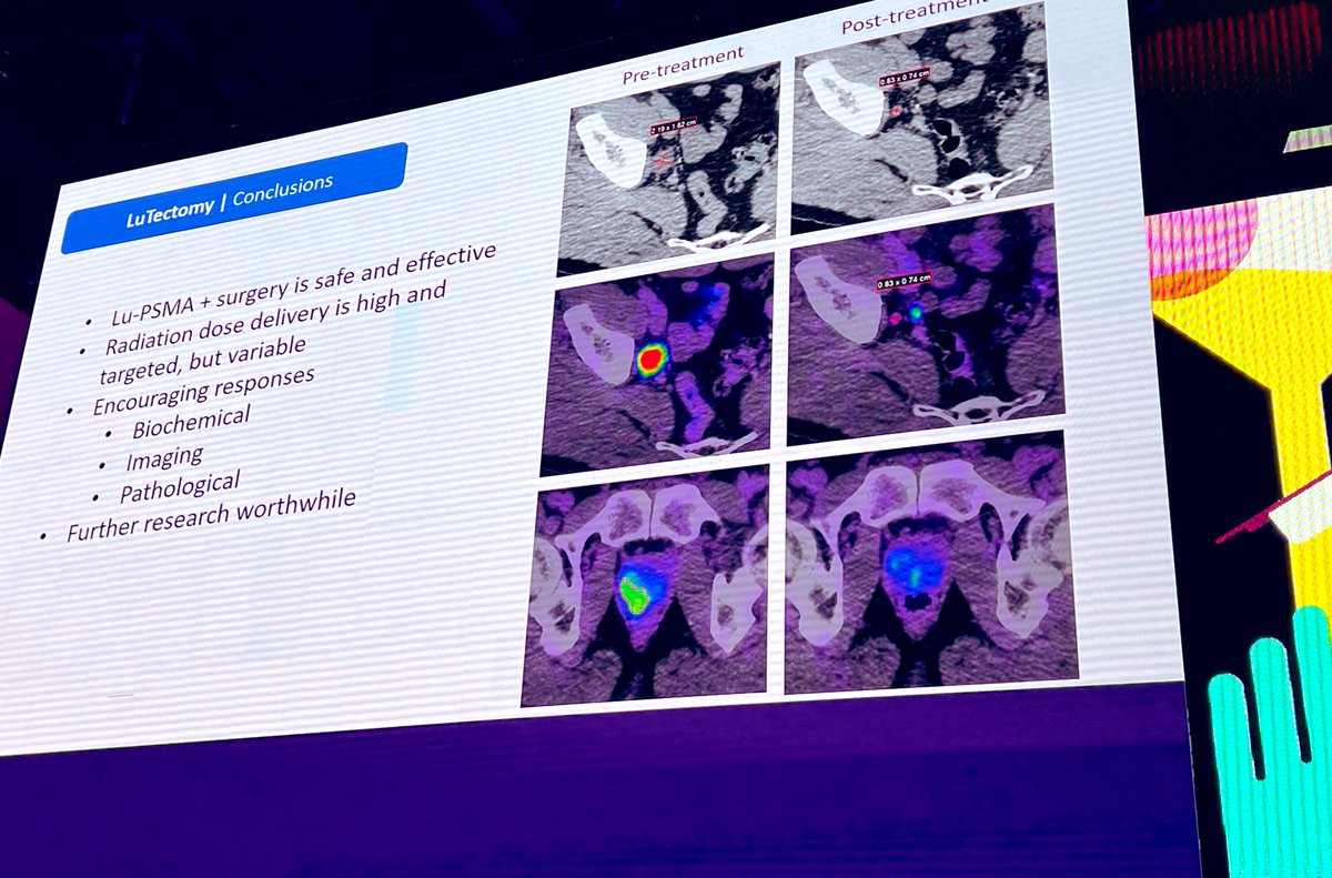 Axel S. Merseburger (@amerseburger) on Twitter photo Congrats ๐ to <a href="/RenuEapen/">Renu Eapen</a> on #LuTectomy trial first presentation #EAU23 <a href="/OncoAlert/">OncoAlert</a> <a href="/Uroweb/">European Association of Urology (EAU)</a> <a href="/urotoday/">UroToday.com</a> <a href="/Albert0Briganti/">Alberto Briganti</a> <a href="/DrMHofman/">Michael Hofman</a> <a href="/ProfKHerrmann/">Ken Herrmann</a> Congrats ๐ to <a href="/RenuEapen/">Renu Eapen</a> on #LuTectomy trial first presentation #EAU23 <a href="/OncoAlert/">OncoAlert</a> <a href="/Uroweb/">European Association of Urology (EAU)</a> <a href="/urotoday/">UroToday.com</a> <a href="/Albert0Briganti/">Alberto Briganti</a> <a href="/DrMHofman/">Michael Hofman</a> <a href="/ProfKHerrmann/">Ken Herrmann</a>