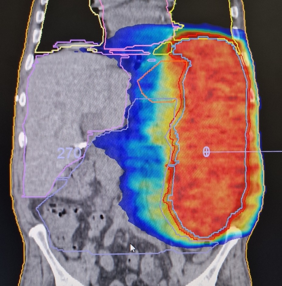 CTuscanoMD's tweet photo. An example of the power of @Elekta MonacoTPS with Linac #VersaHD. 0.2 Gy per fraction delivered by Vmat technique in patient with splenomegaly (38 cm) from MFS ( pre-transplant procedure ‼️). Total delivery of 2 Gy in 10 fractions. #radonc https://t.co/ukHeZN1nW5