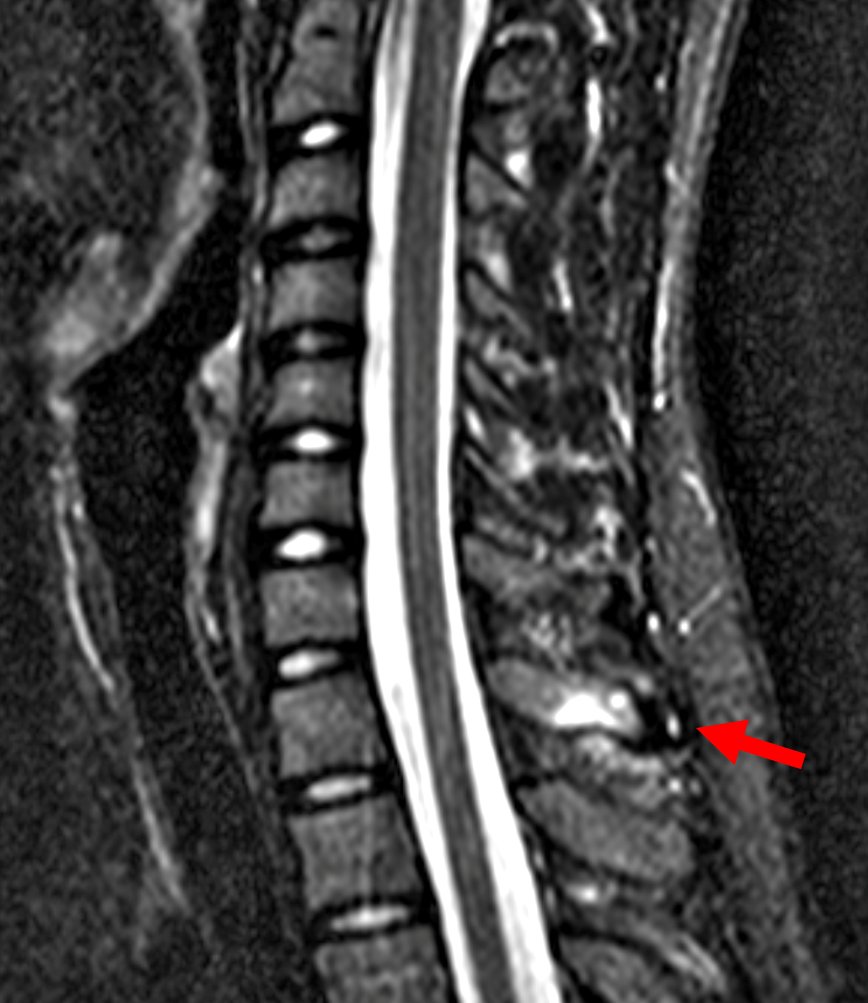 mskteachingroom's tweet image. 14-year-old 👦

Findings 👉spinous process apophyseal stress injury

#spineimaging
#medtwitter
#radtwitter 
#FOAMrad