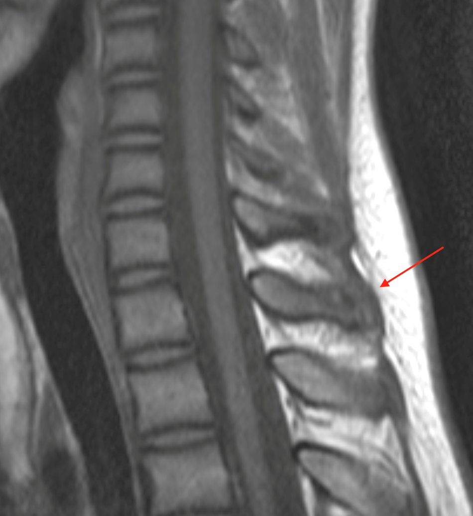 mskteachingroom's tweet image. 14-year-old 👦

Findings 👉spinous process apophyseal stress injury

#spineimaging
#medtwitter
#radtwitter 
#FOAMrad