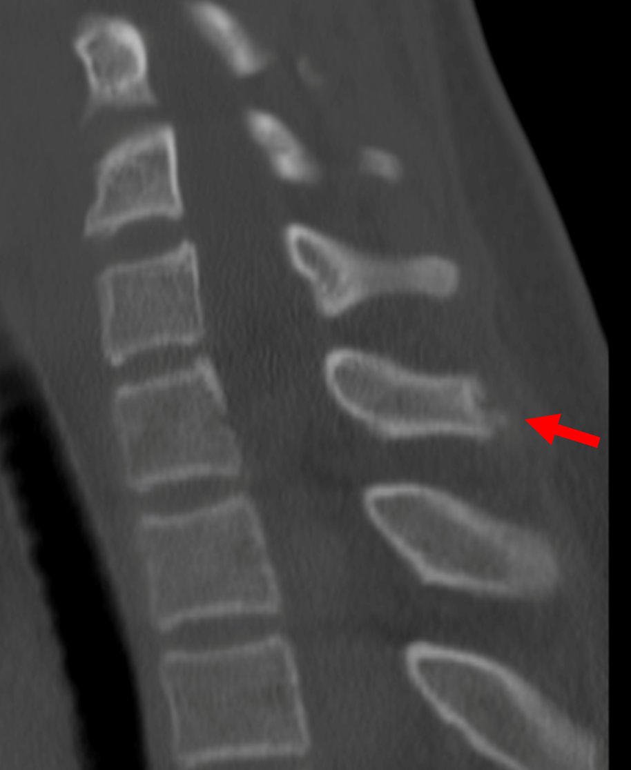mskteachingroom's tweet image. 14-year-old 👦

Findings 👉spinous process apophyseal stress injury

#spineimaging
#medtwitter
#radtwitter 
#FOAMrad