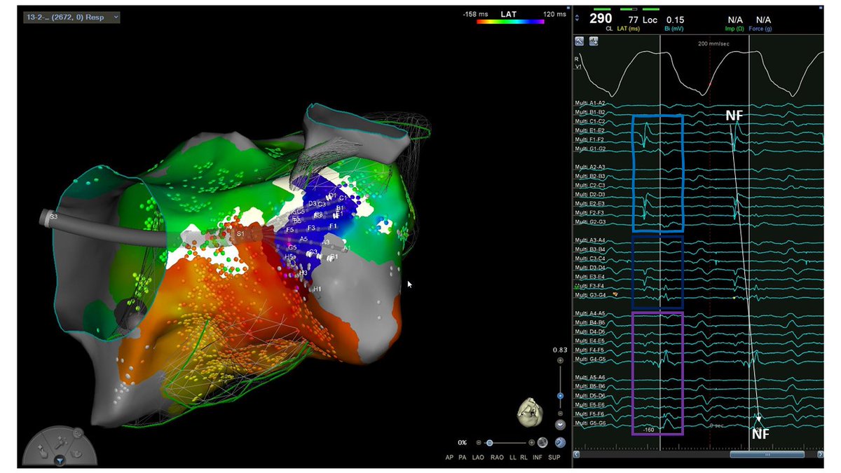 Small diastolic pathway between RV free wall pericardial patch and RVOT