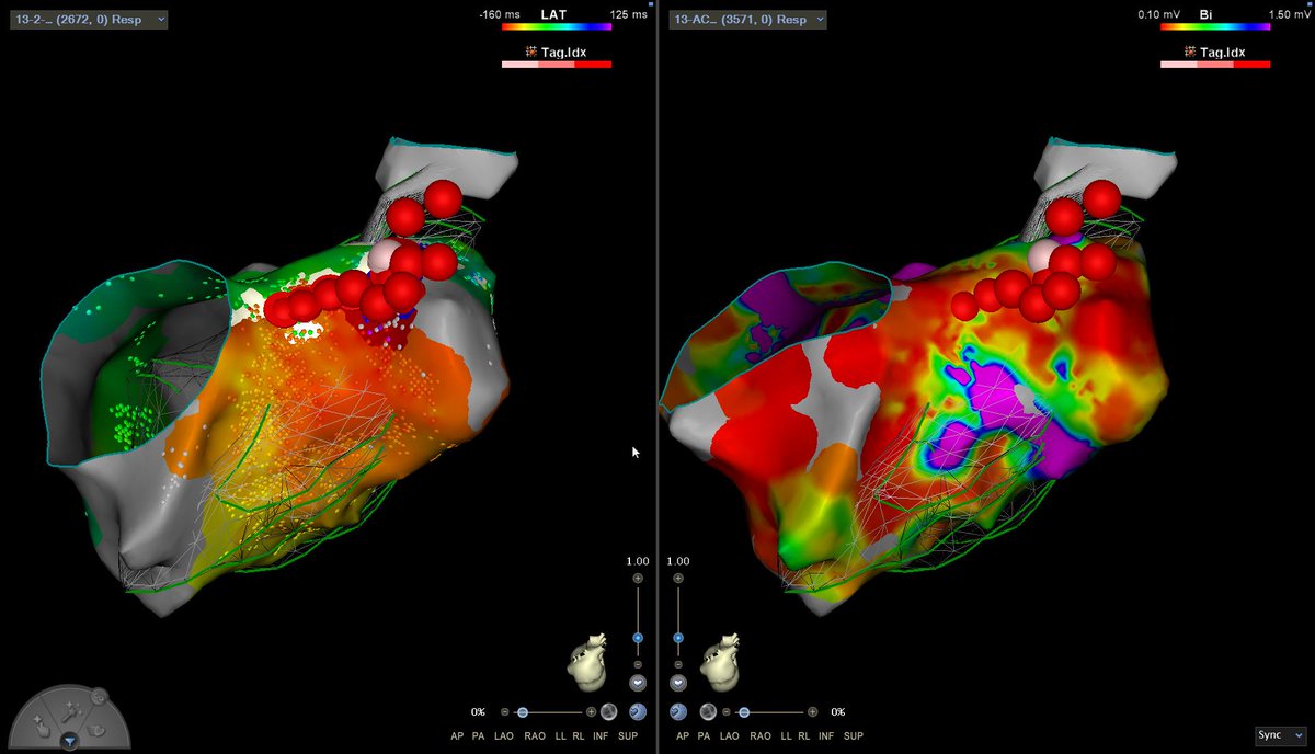 Tachycardia was finished with applications in the isthmus from pericardial patch to pulmonary valve stent (mesh). Aditionally, we performed lesions to complete block between tricuspid annulus and RVOT (functional block during VT, not present during LV pacing map)
