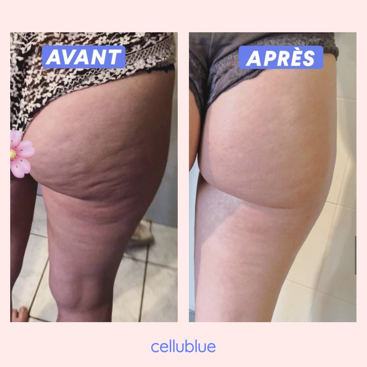 Super photo avant/après de @amandiiin_e 👇👇
"Résultats @cellublue au bout des 21 jours : la promesse est tenue ! Cellulite beaucoup moins présente, peau plus lisse et plus ferme ! Je continue jusqu’à extermination complète 😈"