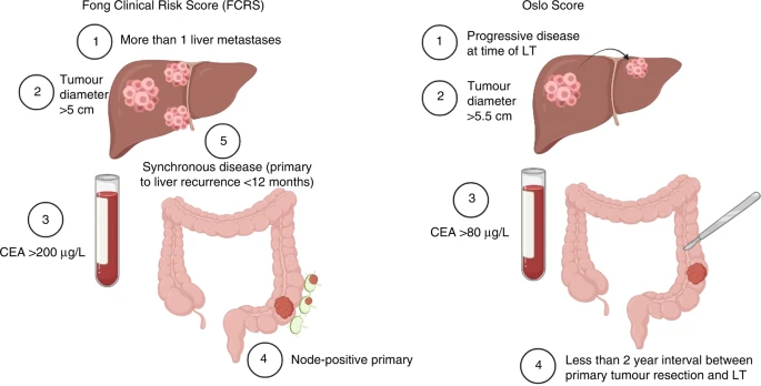 Review paper on Liver tx for CRLM nature.com/articles/s4141… #BrJCaner by Val'd Hebron group /Brecelona @cdopazo1 ++ @hpb_so