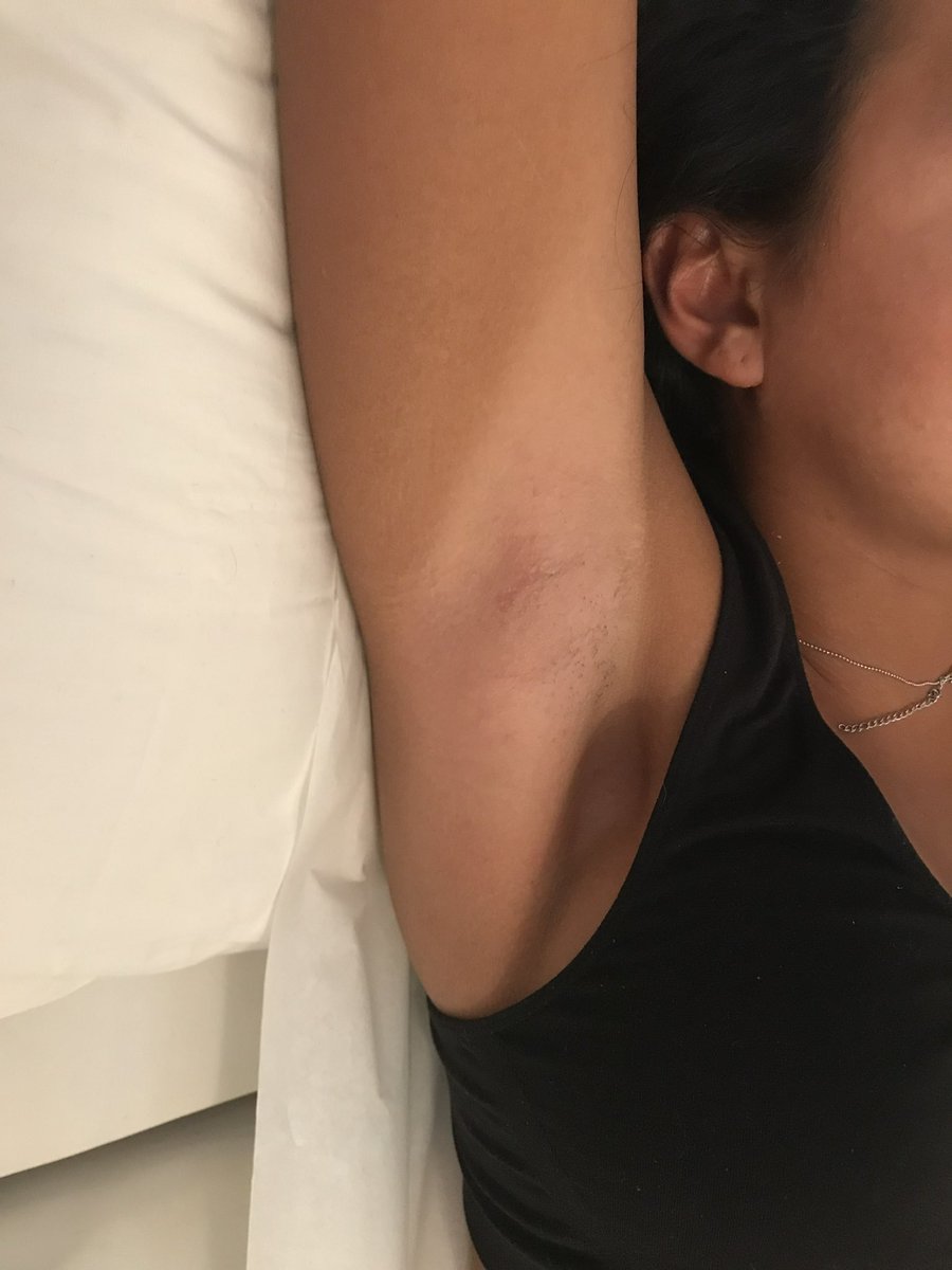 TanliciousTan's tweet image. Who knew underarms can be so sexy✨
.
Don’t miss out on our underarm promo $50 
.
#LaserHairRemoval #underarms #hairfreecarefree #Laser #HairRemoval #Hair #Removal #Toronto #NorthYork
