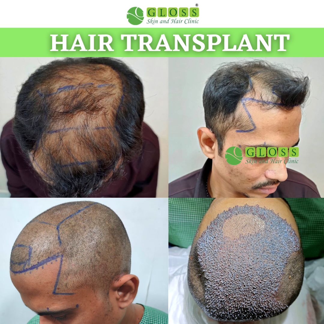 Maximum Grafts Gloss clinic Fue Hair Implantation | Patient name- Rohit

STUNNING RESULTS WITH MAXIMUM GRAFT
Contact us for detailed information 👇🏻
Gloss Skin and Hair Clinic, Mumbai
🌎 glossclinic.com
📞 +917045844882

#hairtranplant #FUE #fuehairtransplant #hairclinic