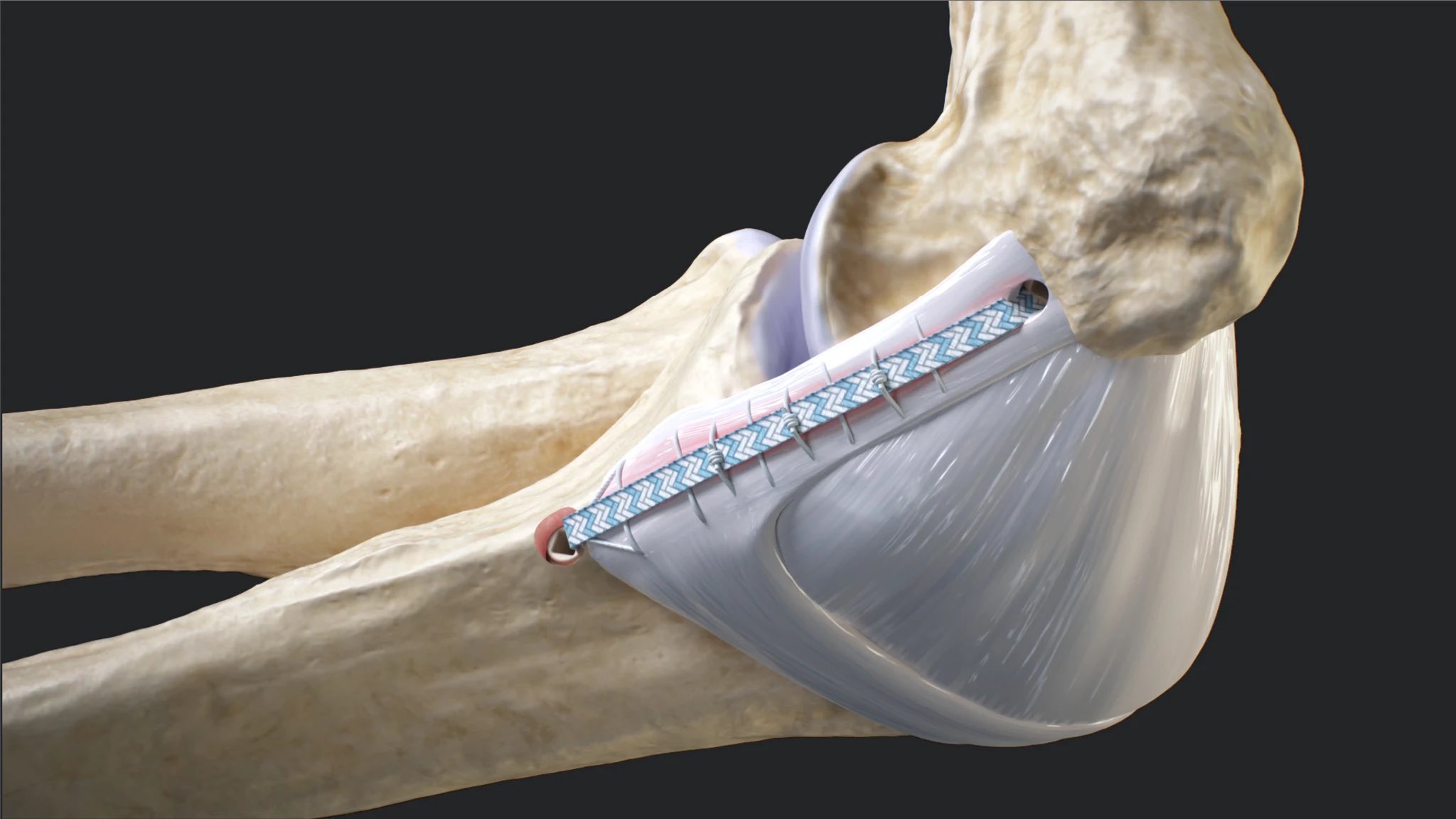 DocFlynn On Twitter RapSheet Hoping For A UCL Repair With Internal
